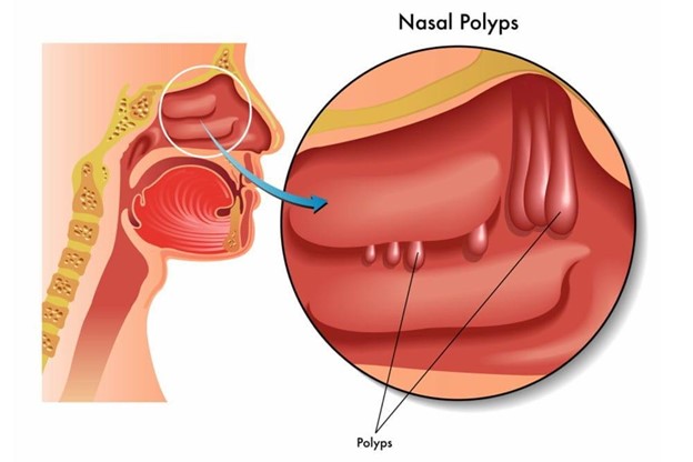 Nasal Polyps